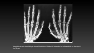 Radiografia das mãos mostra alterações escleróticas nos ossos e um acentuado estreitamento da cavidade medular dos metacarpos e
das falanges.
 