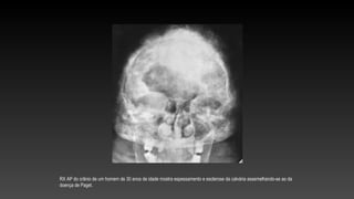 RX AP do crânio de um homem de 30 anos de idade mostra espessamento e esclerose da calvária assemelhando-se ao da
doença de Paget.
 