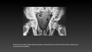 RX AP da pelve mostra o padrão trabecular grosseiro e espessamento da cortical típico desta doença. Observar que
as epífises não são afetadas.
 
