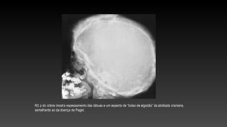 RX p do crânio mostra espessamento das tábuas e um aspecto de “bolas de algodão” da abóbada craniana,
semelhante ao da doença de Paget.
 