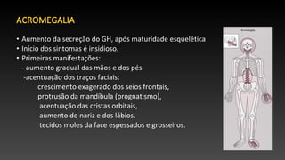 • Aumento da secreção do GH, após maturidade esquelética
• Início dos sintomas é insidioso.
• Primeiras manifestações:
- aumento gradual das mãos e dos pés
-acentuação dos traços faciais:
crescimento exagerado dos seios frontais,
protrusão da mandíbula (prognatismo),
acentuação das cristas orbitais,
aumento do nariz e dos lábios,
tecidos moles da face espessados e grosseiros.
 