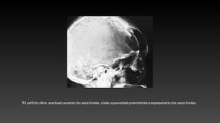 RX perfil do crânio: acentuado aumento dos seios frontais, cristas supra-orbitais proeminentes e espessamento dos ossos frontais.
 