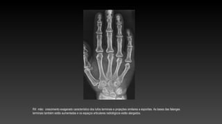 RX mão: crescimento exagerado característico dos tufos terminais e projeções similares a esporões. As bases das falanges
terminais também estão aumentadas e os espaços articulares radiológicos estão alargados.
 