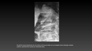 Rx perfil da coluna toracolombar de uma mulher de 49 anos de idade com acromegalia mostra indentação vertebral
posterior, aparentemente causado por reabsorção óssea.
 