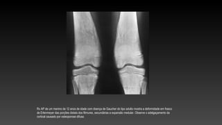 Rx AP de um menino de 12 anos de idade com doença de Gaucher do tipo adulto mostra a deformidade em frasco
de Erlenmeyer das porções distais dos fêmures, secundárias a expansão medular. Observe o adelgaçamento da
cortical causado por osteoporose difusa.
 