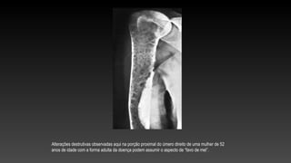 Alterações destrutivas observadas aqui na porção proximal do úmero direito de uma mulher de 52
anos de idade com a forma adulta da doença podem assumir o aspecto de “favo de mel”.
 