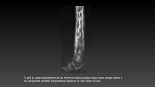 Rx perfil da porção distal do fêmur de uma mulher de 28 anos de idade mostra infarto medular extenso e
neo-osteogênese periosteal, produzindo uma aparência em “osso dentro de osso”.
 