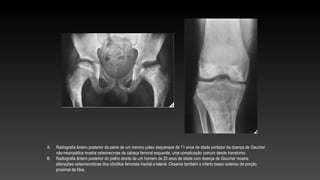 A. Radiografia ântero posterior da pelve de um menino judeu asquenaze de 11 anos de idade portador da doença de Gaucher
não-neuropática mostra osteonecrose da cabeça femoral esquerda, uma complicação comum desde transtorno.
B. Radiografia ântero posterior do joelho direito de um homem de 25 anos de idade com doença de Gaucher mostra
alterações osteonecróticas dos côndilos femorais medial e lateral. Observe também o infarto ósseo extenso da porção
proximal da tíbia.
 
