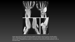 Homem negro de 66 anos de idade apresentava múltiplas tumorações ao redor dos punhos e cotovelos desde a
infância. Radiografias dorsopalmar (A) e lateral (B) dos punhos mostram massas calcificadas na face dorsal logo
abaixo da pele. (C) Radiografia ântero-posterior do cotovelo direito mostra acúmulo de cálcio semelhante a tumor na
face ântero-medial.
 
