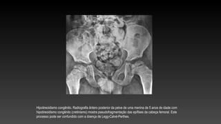Hipotireoidismo congênito. Radiografia ântero posterior da pelve de uma menina de 5 anos de idade com
hipotireoidismo congênito (cretinismo) mostra pseudofragmentação das epífises da cabeça femoral. Este
processo pode ser confundido com a doença de Legg-Calvé-Perthes.
 