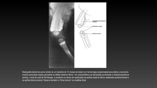 Radiografia lateral da perna direita de um lactente de 10 meses de idade com hemorragia subperiosteal secundária a escorbuto
mostra acentuada reação periosteal na diáfise distal do fêmur. Um anel periférico de densidade aumentada e radiotransparência
central, o sinal do anel de Wimberger, é evidente no centro de ossificação da epífise distal do fêmur deslocado posteriormente e
na epífise tibial proximal. Observe também a “linha branca” na metáfise tibial.
 