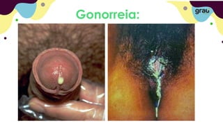 Gonorreia:
 