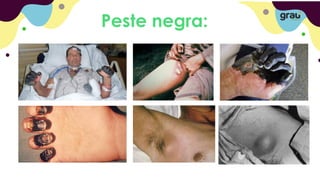 Peste negra:
 