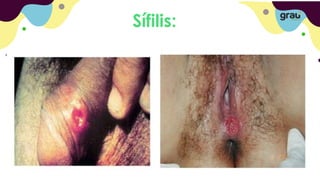 Sífilis:
 