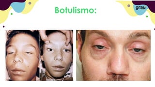 Botulismo:
 