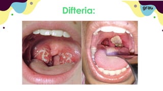 Difteria:
 