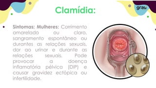 Clamídia:
Sintomas: Mulheres: Corrimento
amarelado ou claro,
sangramento espontâneo ou
durantes as relações sexuais,
dor ao urinar e durante as
relações sexuais. Pode
provocar a doença
inflamatória pélvica (DIP) e
causar gravidez ectópica ou
infertilidade.
 