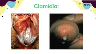 Clamídia:
 