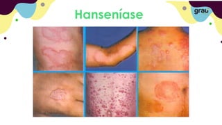 Hanseníase
 