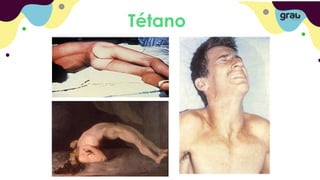Tétano
 