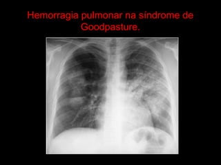 Hemorragia pulmonar na síndrome de
           Goodpasture.
 