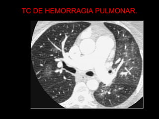 TC DE HEMORRAGIA PULMONAR.
 