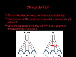 Clínica do TEP

 Ocorre dispnéia, síncope, dor torácica e taquipnéia .
 Hiperfonese de B2, turgência de jugular e impulso do VD
  palpável.
 Deve-se pesquisar sintomas de TVP ( dor, edema e
  empastamento muscular )
 