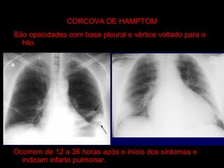 CORCOVA DE HAMPTOM
São opacidades com base pleural e vértice voltado para o
  hilo.




Ocorrem de 12 a 36 horas após o início dos sintomas e
  indicam infarto pulmonar.
 