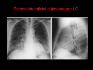 Edema intersticial pulmonar por I.C.
 