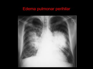 Edema pulmonar perihilar
 