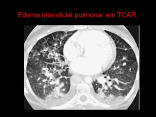 Edema intersticial pulmonar em TCAR.
 