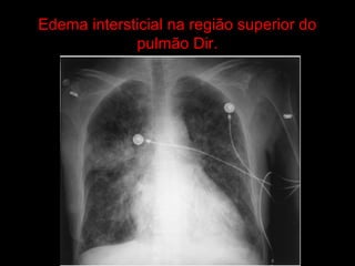 Edema intersticial na região superior do
             pulmão Dir.
 