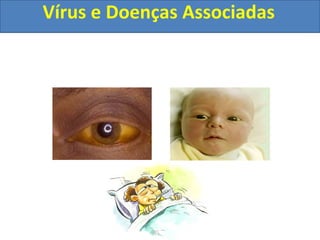Vírus e Doenças Associadas
 