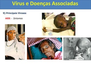 Vírus e Doenças Associadas
9) Principais Viroses
AIDS - Sintomas
 