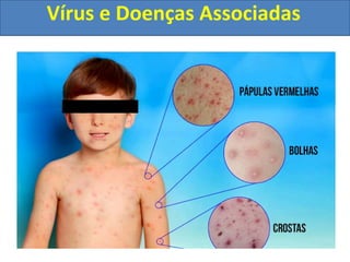 Vírus e Doenças Associadas
 