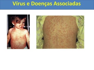 Vírus e Doenças Associadas
 