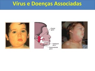 Vírus e Doenças Associadas
 