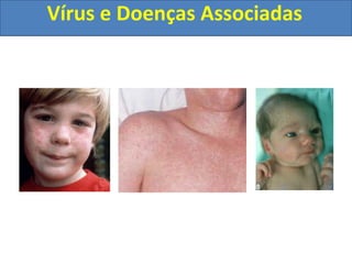 Vírus e Doenças Associadas
 