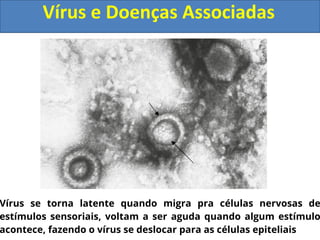 Vírus e Doenças Associadas
Vírus se torna latente quando migra pra células nervosas de
estímulos sensoriais, voltam a ser aguda quando algum estímulo
acontece, fazendo o vírus se deslocar para as células epiteliais
 