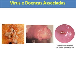 Vírus e Doenças Associadas
Lesão causada pelo HPV
na parede do colo uterino
 