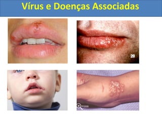 Vírus e Doenças Associadas
 