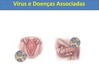 Vírus e Doenças Associadas
 