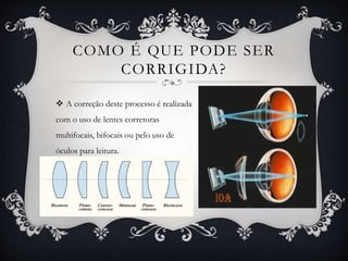 COMO É QUE PODE SER
CORRIGIDA?
 A correção deste processo é realizada
com o uso de lentes corretoras
multifocais, bifocais ou pelo uso de
óculos para leitura.
 