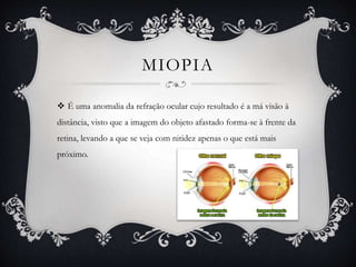 MIOPIA
 É uma anomalia da refração ocular cujo resultado é a má visão à
distância, visto que a imagem do objeto afastado forma-se à frente da
retina, levando a que se veja com nitidez apenas o que está mais
próximo.
 