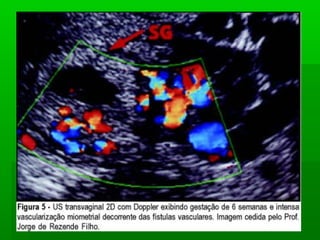 Doença trofoblastica gestacional