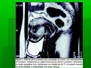 Doença trofoblastica gestacional