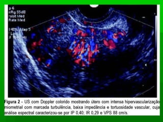 Doença trofoblastica gestacional