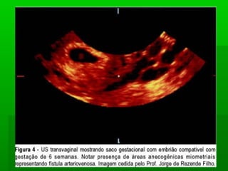 Doença trofoblastica gestacional