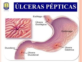 ÚLCERAS PÉPTICAS
 