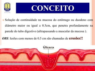  Solução de continuidade na mucosa do estômago ou duodeno com
diâmetro maior ou igual a 0.5cm, que penetra profundamente na
parede do tubo digestivo (ultrapassando a muscular da mucosa ).
OBS: lesões com menos de 0.5 cm são chamadas de erosões!!
CONCEITO
 